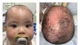 Tắm lá chữa viêm da đầu sai cách, trẻ 8 tháng bị bội nhiễm vi khuẩn nặng