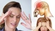 Đau nửa đầu Migraine tiềm ẩn nguy cơ đột quỵ não