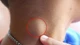Nổi hạch không chỉ viêm nhiễm mà có thể lao, ung thư