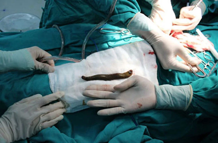 Những trường hợp đỉa chui vào người kinh hãi nhất