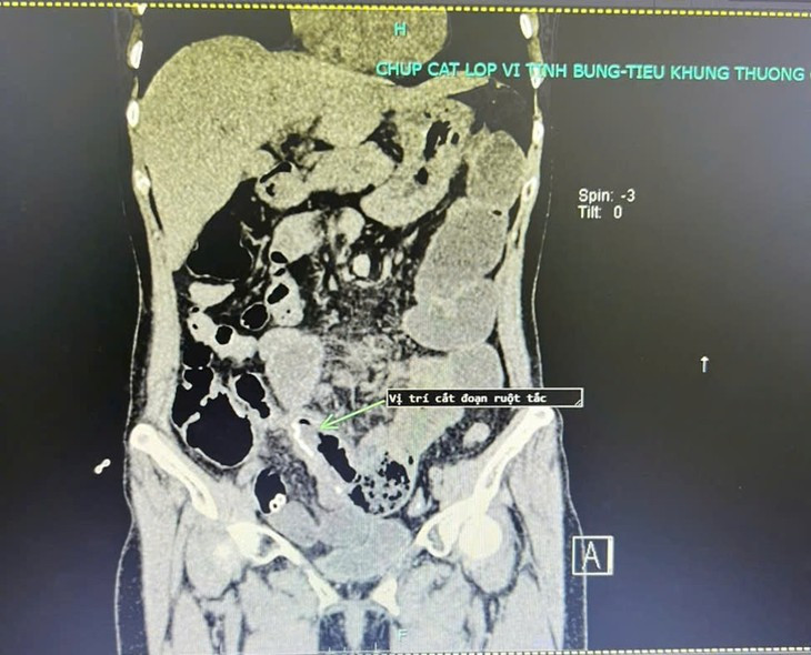 Đau bụng, nôn... đi khám phát hiện dính ruột, bệnh biến chứng nguy hiểm ...