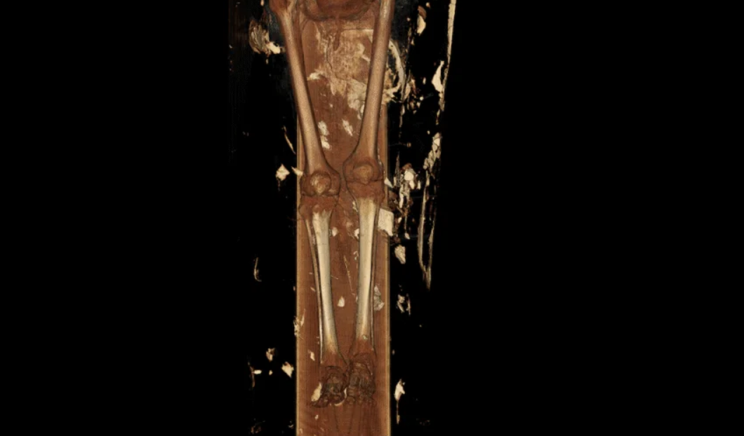 Xác ướp Nes Hor lại có những vấn đề khác. Hình ảnh cho thấy sâu răng nghiêm trọng ở một số răng và thoái hóa nặng ở một khớp hông. Tổn thương khớp loại này thường dẫn đến hạn chế vận động và đau khi đi lại. Tình trạng xương cho thấy Nes Hor qua đời ở tuổi cao hơn Nes Min. Ảnh: @Đại học Nam California.