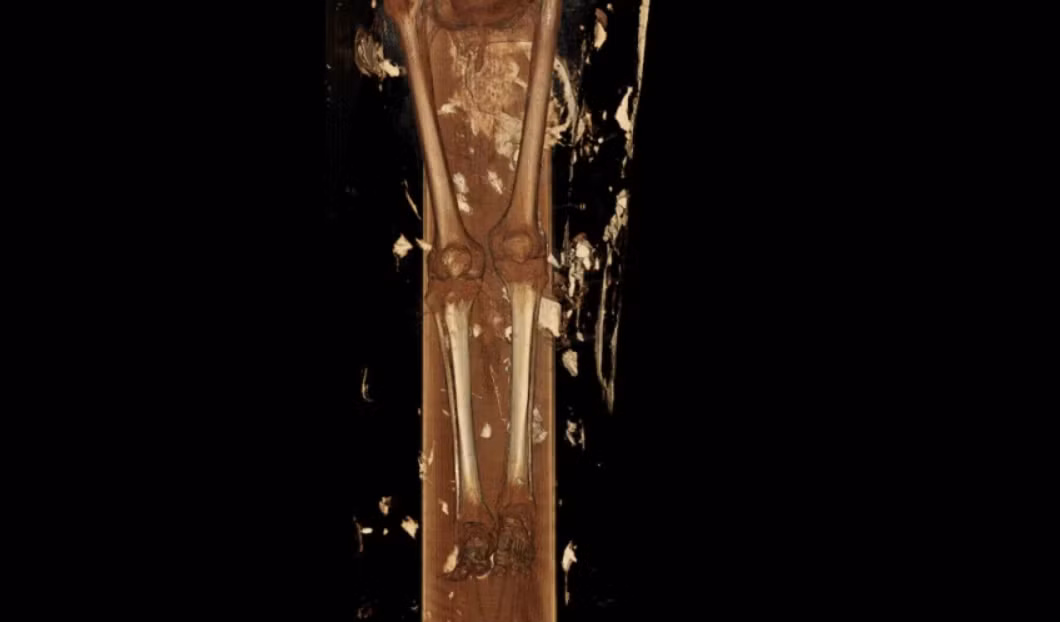 Xác ướp Nes Hor lại có những vấn đề khác. Hình ảnh cho thấy sâu răng nghiêm trọng ở một số răng và thoái hóa nặng ở một khớp hông. Tổn thương khớp loại này thường dẫn đến hạn chế vận động và đau khi đi lại. Tình trạng xương cho thấy Nes Hor qua đời ở tuổi cao hơn Nes Min. Ảnh: @Đại học Nam California.