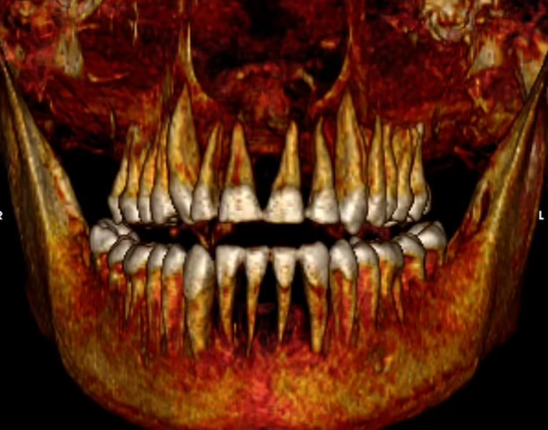 Những hình ảnh chụp này cũng xác nhận rằng. Amenhotep I cao khoảng 1,67 mét và có hàm răng được bảo quản tốt. Mặc dù các cuộc quét hình ảnh không thể xác định nguyên nhân tử vong. Ảnh: @Cicero Moraes.