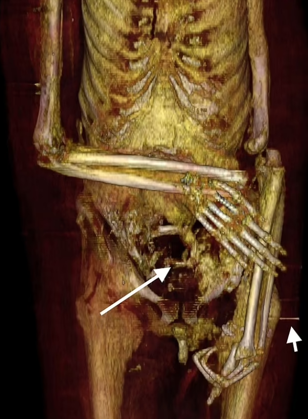 Sử dụng các kỹ thuật tiên tiến nhất, Moraes đã kết hợp dữ liệu từ nhiều nguồn khác nhau, bao gồm cả ảnh chụp cắt lớp vi tính (CT) hộp sọ của pharaoh này. Kết quả chụp CT đã tiết lộ những chi tiết quan trọng về ngoại hình của pharaoh, bao gồm cấu trúc xương và một số cơ quan nội tạng được bảo quản tốt như tim và não. Ảnh: @Cicero Moraes.