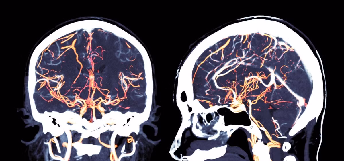 Họ cũng đã sử dụng phương pháp chụp cắt lớp vi tính (CT) từ não bộ của những người hiến tặng tự nguyện còn sống, và áp dụng thông tin đó để điều chỉnh cấu trúc hộp sọ, bằng cách đưa vào các dấu hiệu độ dày mô, đồng tác giả nghiên cứu Cícero Moraes, một chuyên gia đồ họa người Brazil chia sẻ. Ảnh: @I-MED Radiology Network.
