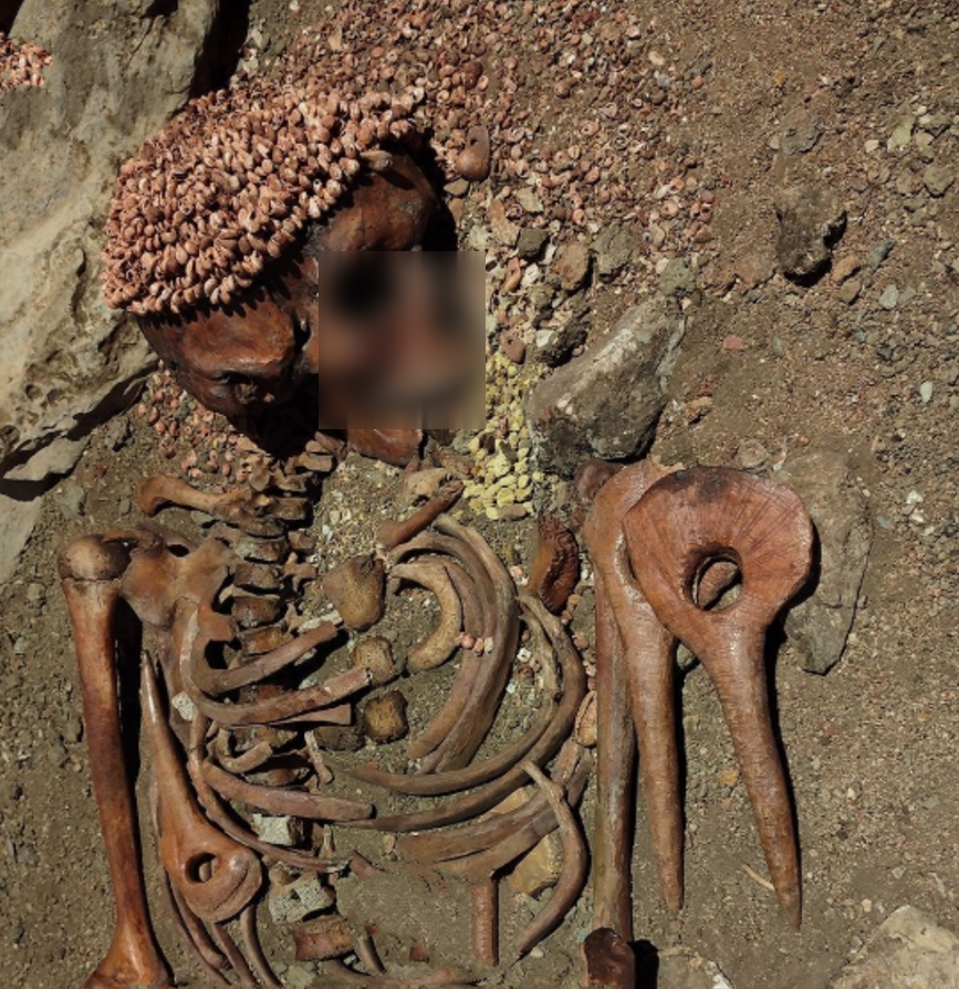 Bộ hài cốt bị gãy xương đòn và một lỗ lớn ở hàm. Vị hoàng tử này cũng bị nhiều vết nứt ở hộp sọ, răng và cổ, cũng như bị thủng xương mác (xương bắp chân). Ảnh: @Đại học Anadolu.