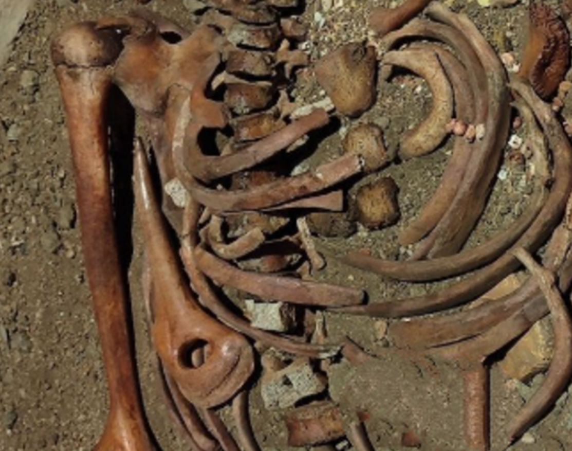 Các nhà nghiên cứu đến từ trường Đại học Anadolu cho biết: "Mô hình chấn thương tổng thể quan sát được ở cá thể này tương tự như các chấn thương thường được ghi nhận trong các vụ tai nạn xe cơ giới hiện đại. Tuy nhiên, trong bối cảnh thời tiền sử được nghiên cứu ở đây, chúng tôi tin rằng, điều này có nhiều khả năng là do bị một con vật lớn tấn công, có thể là bị gấu vồ”. Ảnh: @Đại học Anadolu.