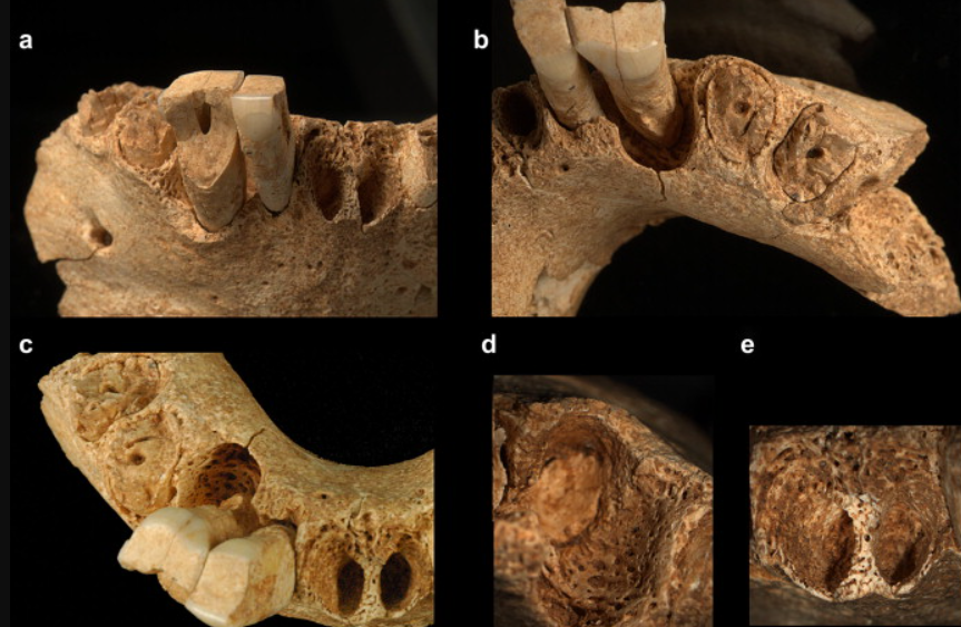 Mô tả chi tiết cho thấy, đây là hài cốt của chủng người Homo erectus, chứ không phải Homo antecessor, và Homo erectus có thể là tổ tiên loài người đầu tiên đặt chân đến Tây Âu. Ảnh: @Trung tâm Nghiên cứu Quốc gia về Tiến hóa Loài người.