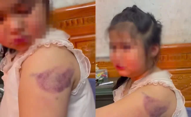 Học sinh lớp 1 nghi bị cô giáo đánh tím tay vì viết xấu