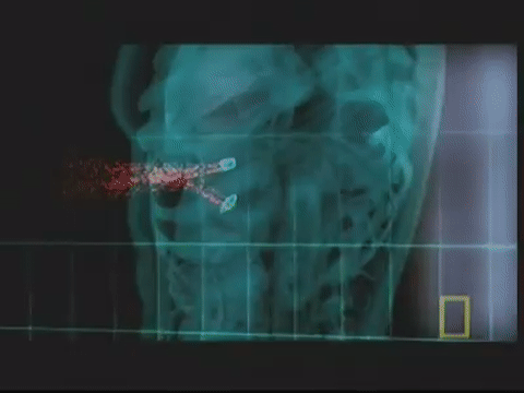 Tiếp theo đó, do gia tốc viên đạn không đồng nhất nên viên đạn sẽ bị bẻ đôi và vỡ thành nhiều mảnh, đầu đạn sẽ quay 180 độ đến khi bay ra ngoài cơ thể nạn nhân trong khi đuôi đạn và nhiều mảnh vỡ khác di chuyển sâu hơn vào bên trong cơ thể của nạn nhân. Nguồn ảnh: Gify.