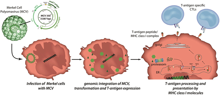 MCV là một loại virus phổ biến trên da mặc dù hiếm khi gây ung thư. Ở người khỏe mạnh thì virus này tự bong ra khỏi da. Virus này gây u tế bào Merkel. (Nguồn ảnh: Medscience)