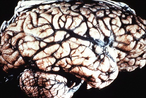 Kuru là bệnh não bọt biển gây chết người và là bệnh lây. Đây là bệnh do prion – tác nhân lây nhiễm nhỏ bé nhất từng được biết đến trong lịch sử y học, tương tự như bệnh não bọt biển ở bò hay còn gọi là bệnh bò điên. 