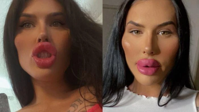 Gái xinh chi tiền tỉ để có được “đôi môi khổng lồ” gây sốt