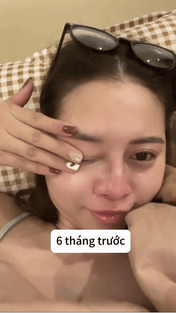 Nhưng chuyện là, filler trên mặt bạn cô sau 6 tháng - 1 năm thì đã tan hết, nhưng riêng Việt Phương Thoa thì từ lúc tiêm đến hiện tại (6 năm) thì cục bên má và dưới cằm vẫn cứ cứng và không có dấu hiệu tự tan.