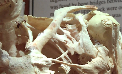 Sự thật khó tin về hội chứng người hoá đá