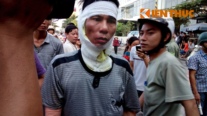 Anh Hoàng Văn Dinh, quê ở Hà Nam, một công nhân bị bỏng nặng phần đầu, vai và lưng kể lại giây phút thoát khỏi đám cháy: "Khi lửa bùng phát, tôi và những công nhân khác đang nghỉ trưa. Lửa cháy quá nhanh, nên tôi không chạy kịp".