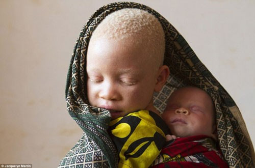 Hiện tượng kì thị này khá phổ biến không chỉ ở Tanzania nói riêng mà còn ở các quốc gia châu Phi khác nữa. Với quan niệm mù quáng rằng những người bị bạch tạng tiềm ẩn ma thuật và có khả năng đem lại may mắn, các phù thủy thường bảo những ma cô đi lấy các bộ phận trên cơ thể họ để làm thuốc chữa bệnh hay bùa chú. Một vài người trong số họ thậm chí còn tưởng, nhờ các bộ phận trên người bạch tạng đó, con người còn trở nên vô hình.