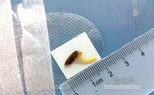 Gần đây, một lão nông Trung Quốc tên là Hoàng Cương, sống tại Vũ Hán, đi khám vì mắt sưng lớn, đau nhức và có mủ kéo dài, và được phát hiện có một hạt thóc đã nảy mầm dài tới 1,8cm trong mắt. Hạt thóc đã bắn vào mắt 1 tháng trước khi người đàn ông 71 tuổi này thu hoạch lúa, nhưng lúc đó bác sĩ bảo chỉ xước nhẹ giác mạc. Nếu để thêm một thời gian nữa, cây lúa sẽ mọc lớn hơn và mắt ông sẽ có nguy cơ bị hỏng.