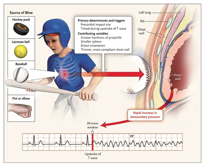 Có khoảng 125 trường hợp commotio cordis được ghi nhận, bao gồm một số cầu thủ hockey trẻ tử vong do bị đĩa tròn va đập vào ngực. Một số ý kiến cho rằng các cao thủ "điểm mạch" biết một cú đánh vào ngực có thể gây ra commotio cordis làm chết người. Tuy vậy, điều này không lý giải được việc có những người được cho là tử vong sau đó một thời gian dài.