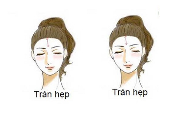 1. Trán hẹp. Trong tướng mạo, trán đại diện cho tâm trí, gia cảnh và tài lộc của một người. Nếu trán của một người tương đối hẹp có nghĩa là gia cảnh không tốt, người này nhìn chung có học lực trung bình, chỉ có thể dựa vào bản thân mà làm việc chăm chỉ trong mọi việc, từ nhỏ cuộc sống đã rất vất vả, anh ấy không thể nhận được sự giúp đỡ và hỗ trợ từ gia đình của mình.