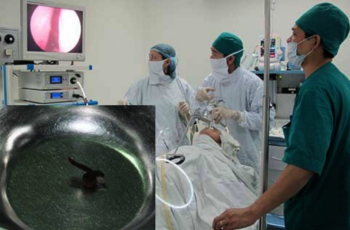 Anh Nguyễn Ngọc D. (tập thể Thanh Xuân, Hà Nội) sau khi đi du lịch Suối Hai về khoảng 2 tháng mới được bác sĩ phát hiện và gắp ra con đỉa sống trong mũi. (Ảnh minh họa)