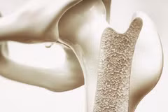 Xương dễ loãng nếu ăn nhiều 5 loại thực phẩm này