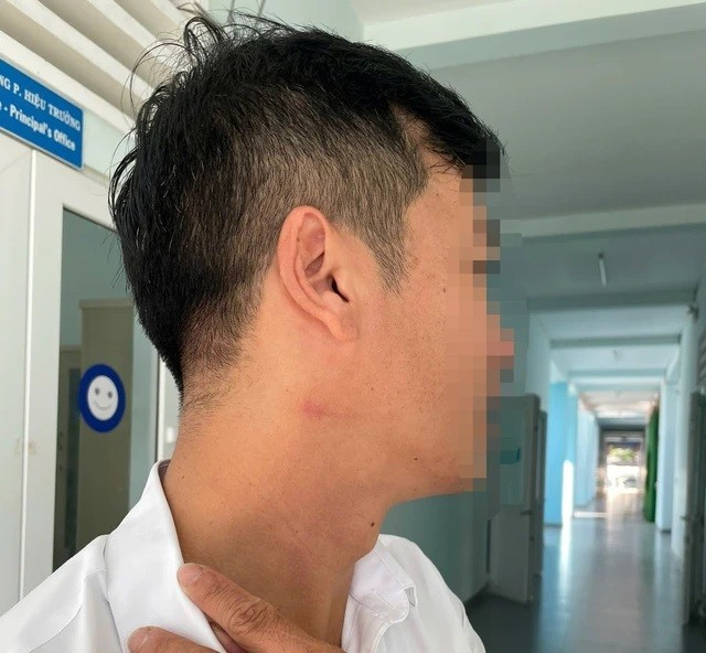 Thầy Sinh bị thương tích ở cổ, ảnh hưởng tâm lý sau khi bị đồng nghiệp bóp cổ. (Ảnh: Tiền Phong) 1-2843.jpg