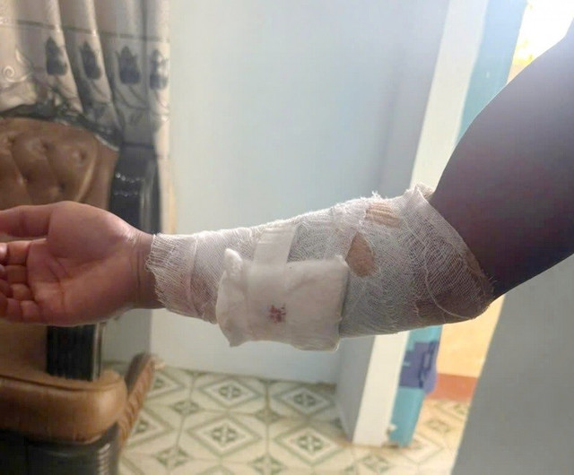 Vết thương trên cánh tay phải của anh Hà Kim Quang bị cá sấu sổng chuồng tấn công đã được sơ cứu, băng bó. 1-7642.jpg