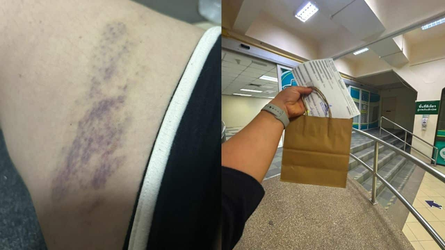 Cô gái may mắn chỉ bị bầm tím nhẹ sau sự việc.