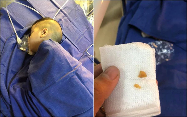 Bé trai nguy kịch vì thói quen nhiều mẹ vẫn chiều khi cho con ăn