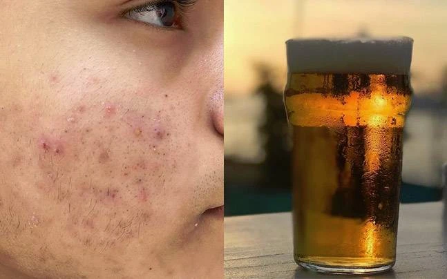 Thoa bia lên mặt chống nhăn đẹp da, nhiều cô gái gặp quả đắng