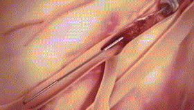 Công nghệ hút chân không để loại bỏ các cục máu đông ứ đọng trong mạch máu.