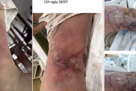 Người đàn ông 59 tuổi nhiễm vi khuẩn Vibrio vulnificus gây hoại tử da nhanh