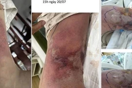 Người đàn ông 59 tuổi nhiễm vi khuẩn Vibrio vulnificus gây hoại tử da nhanh