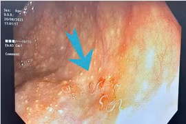 Đại tràng người phụ nữ 63 tuổi nhiều giun ký sinh