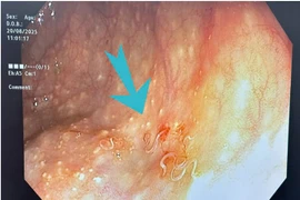 Đại tràng người phụ nữ 63 tuổi nhiều giun ký sinh