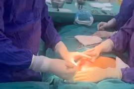 Ngực biến dạng, chảy mủ vì tiêm chất làm đầy từ 5 năm trước