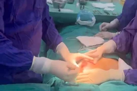 Ngực biến dạng, chảy mủ vì tiêm chất làm đầy từ 5 năm trước