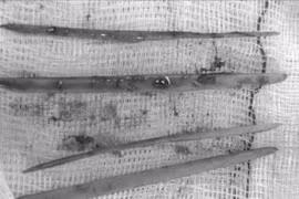 Nữ bệnh nhân cấp cứu vì nuốt tăm tre, nguy hiểm tính mạng