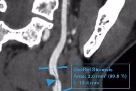 Người đàn ông mắc căn bệnh nguy hiểm do hút thuốc lá gần 30 năm