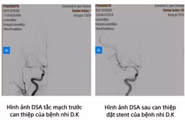 Trẻ 8 tuổi bị đột quỵ, cảnh báo bệnh ngày càng trẻ hoá