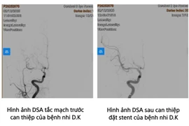 Trẻ 8 tuổi bị đột quỵ, cảnh báo bệnh ngày càng trẻ hoá