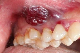Dấu hiệu ban đầu của ung thư khoang miệng