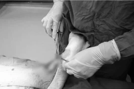 Chủ quan vết xước nhỏ, người đàn ông bị áp xe, nhiễm khuẩn huyết 