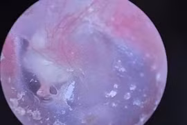 Bé trai 6 tuổi mắc bệnh cholesteatoma tai giữa phá hủy xương