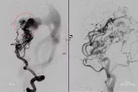 Bé gái 10 tuổi vượt qua 8 lần can thiệp mạch máu não 