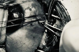 Bệnh nhân bị đinh sắt bắn vào mắt suýt thủng nhãn cầu