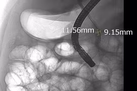 Một bệnh nhân nam 44 tuổi bị tắc mật nặng do sỏi ống mật chủ
