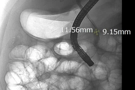 Một bệnh nhân nam 44 tuổi bị tắc mật nặng do sỏi ống mật chủ